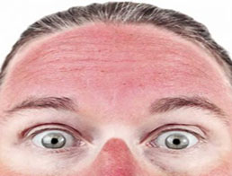 Рак шкіри: відвідування соляріїв, сонячні опіки та вибір сонцезахисного крему
