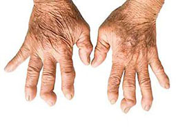 Ревматоїдний артрит: чи ефективна біологічна терапія?