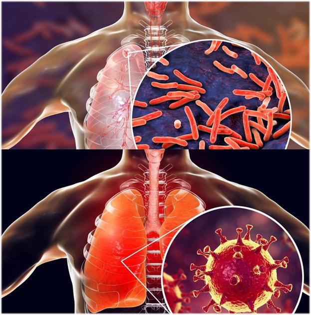 Пандемія КОВІД і туберкульоз.