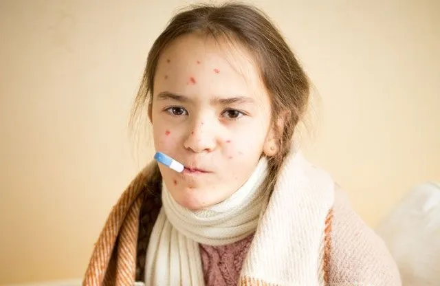 23 людини захворіли на кір в Україні з початку року: як захиститися від недуги