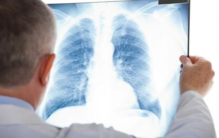 ШІ для діагностики туберкульозу в Україні